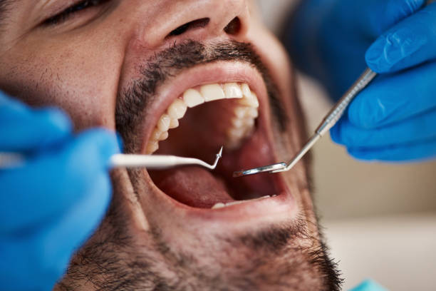 Best Emergency Dental Care for Abscessed Tooth in Maplewood, MO